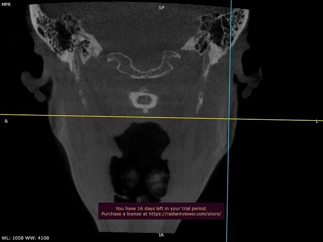 Coronal Plane CBCT