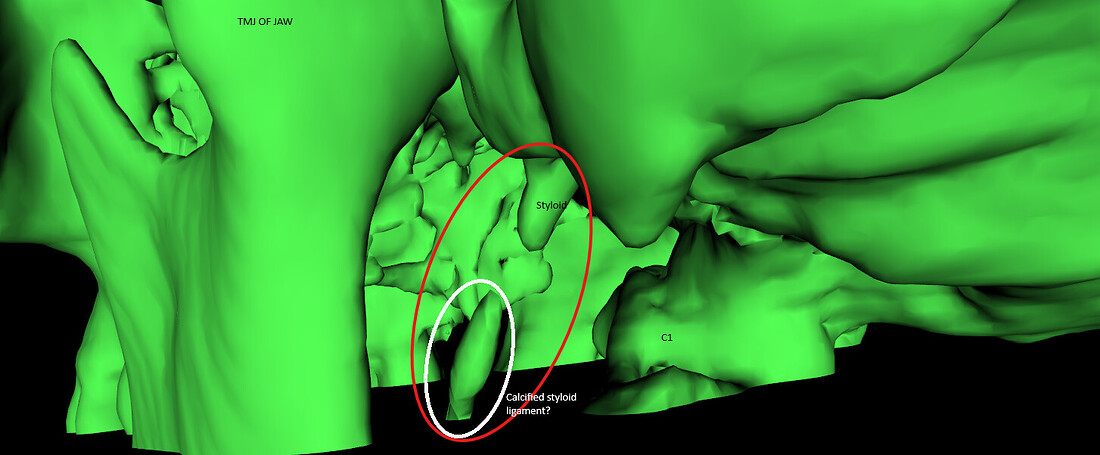 3D labeled CT