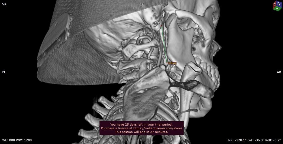 Styloid Process Right Measurement
