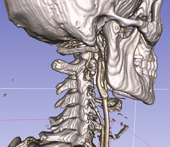 Right_Artery.PNG
