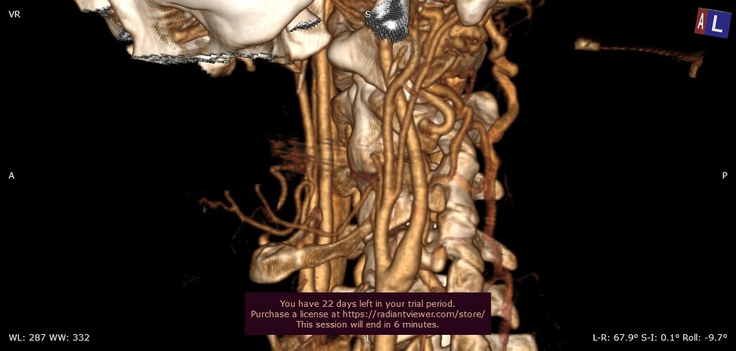 left calcified ligament missing jugular with contrast