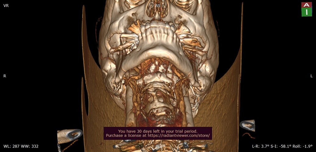 3D_VR_-__(48y)-27_02_2025_15_05_10-_SOFT_TEMPORAL_BONES_1.25MM_0000