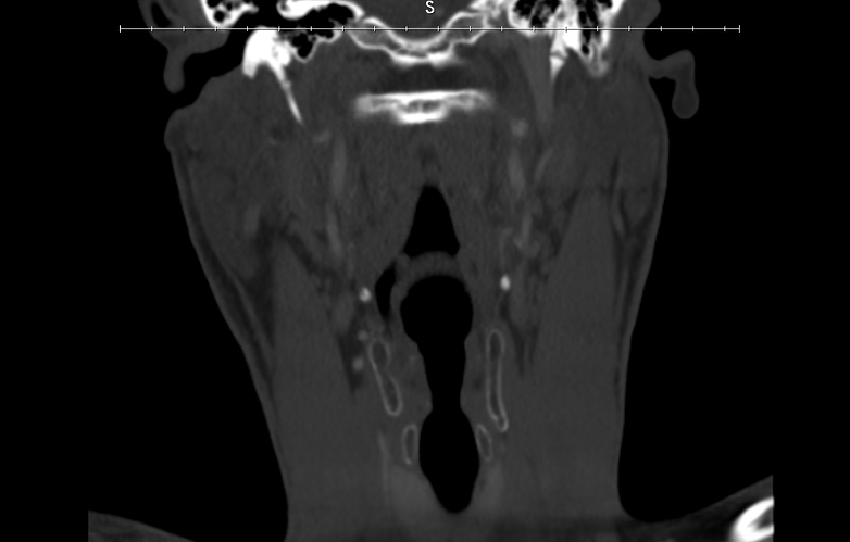 CT 1