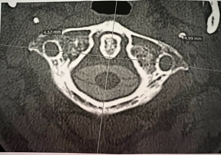 CT Myleogram Syloids Overhead View 4-24-2022