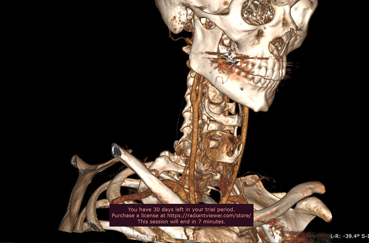 Right greater horn of the hyoid.PNG