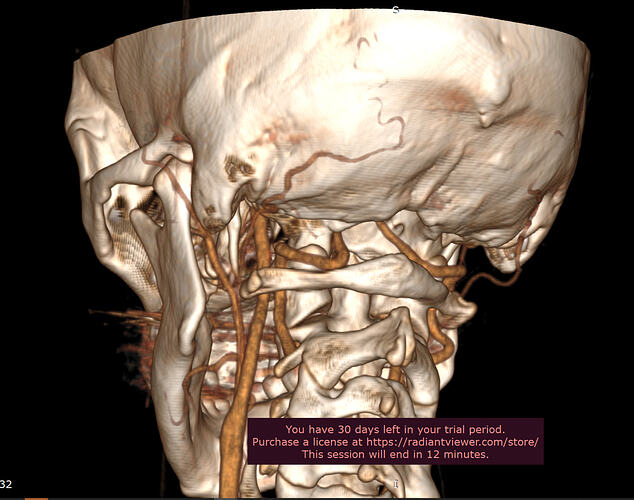 Left styloid (1).PNG