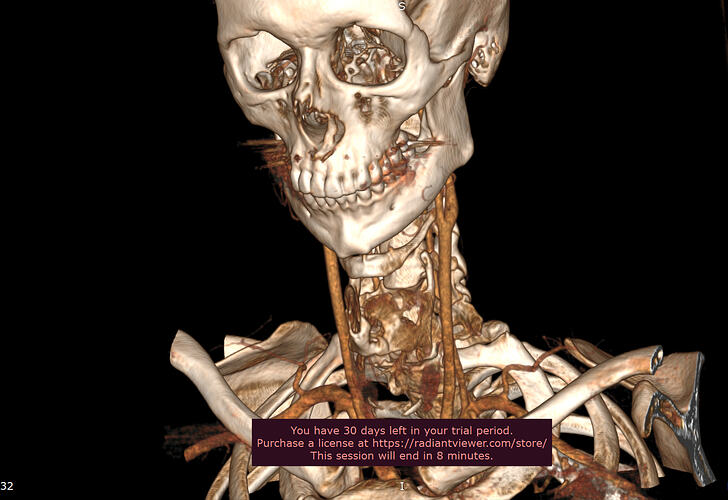 Left greater horn of the Hyoid(1).PNG