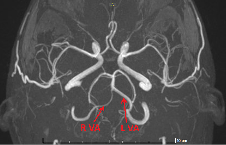 Vertebral arteries 1