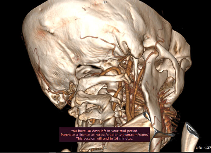 Right styloid(3).PNG