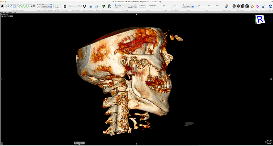 Screenshot_styloid_R.png