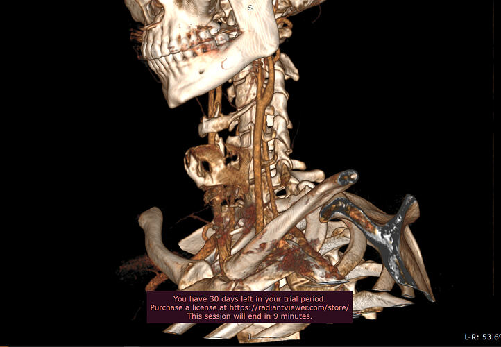 Left greater horn of the Hyoid.PNG