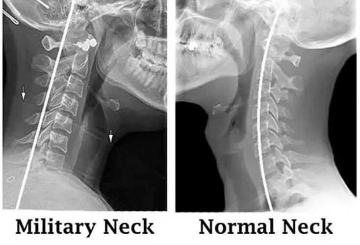 Cervical Curve Military vs Normal