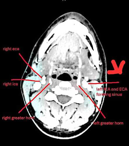 Left ICA AND ECA FORMING SINUS ON LEFT SIDE OF EAGLE BONE