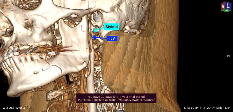 3D_VR_-__(48y)_-27_02_2025_15_05_10-_CTA_CTV_DLIR-H_0003