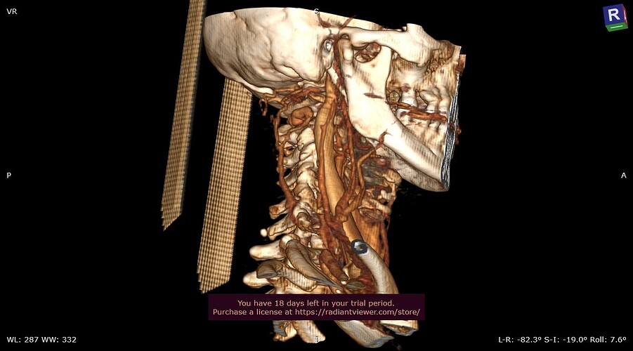 3D_VR_-Anonymous_1D6173AA82C1C52C425135AAAB4E8691E805BC07-16_09_2025_13_54_50-_CORO_BIPHASIQUE_1.5mm_Range_0001