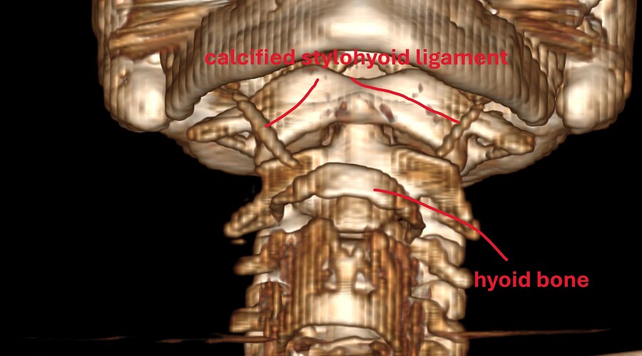 muscl4