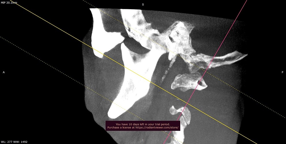 Right Side CBCT
