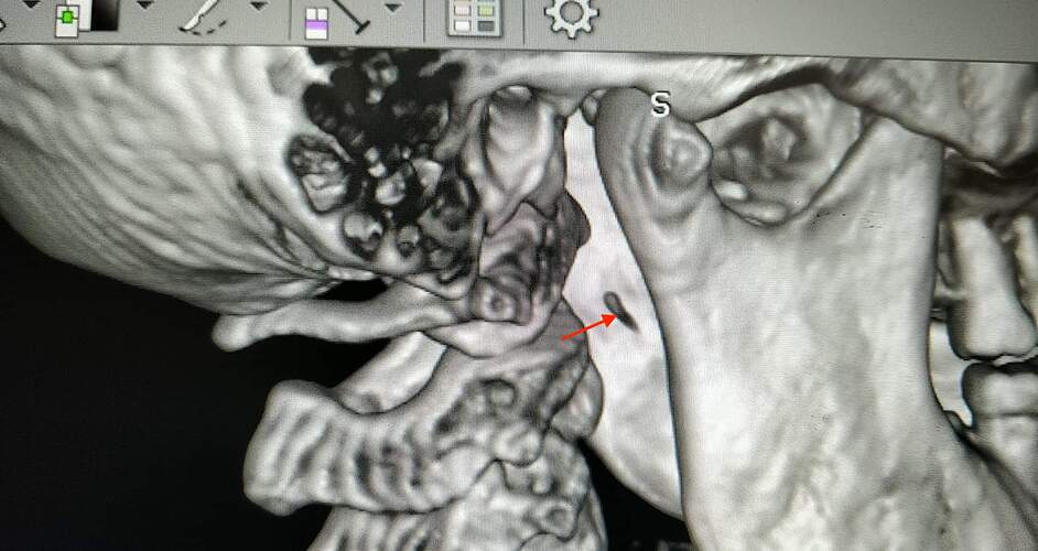 Artifact or Calcified S-H Ligament?
