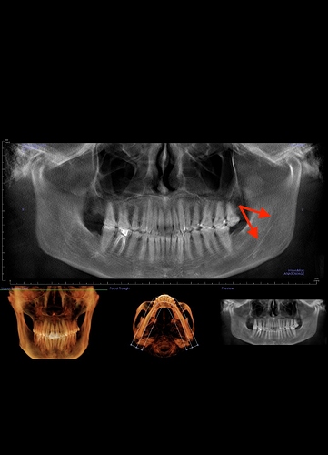 Newuserhere styloid?