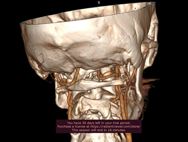 Right styloid(2).PNG