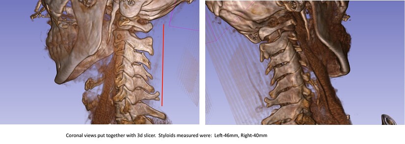 coronal left and right