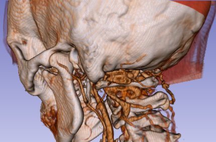 Screenshot_coronary