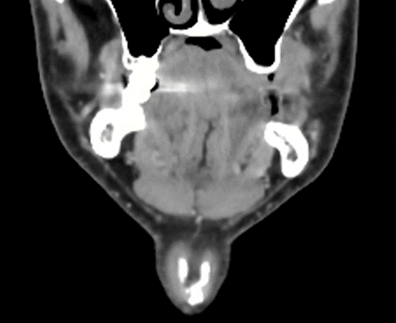 hyoid_bone_coronal_f2b