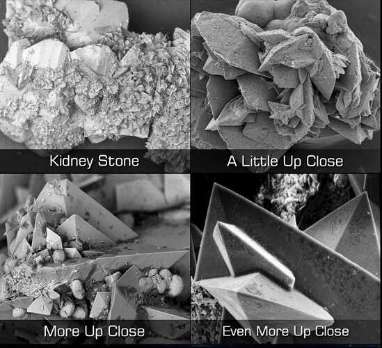 Kidney Stones