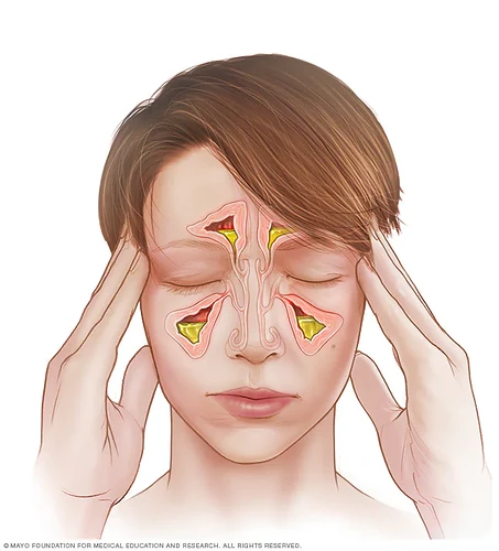 mcdc7_acute_sinusitis-8col